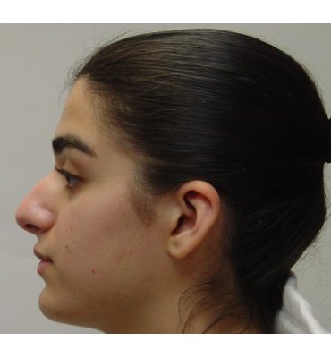 Cosmetic nose surgery